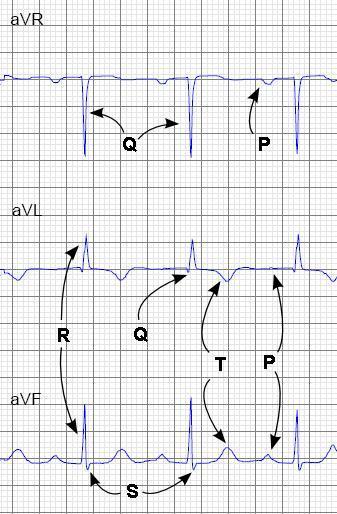 ekg waves