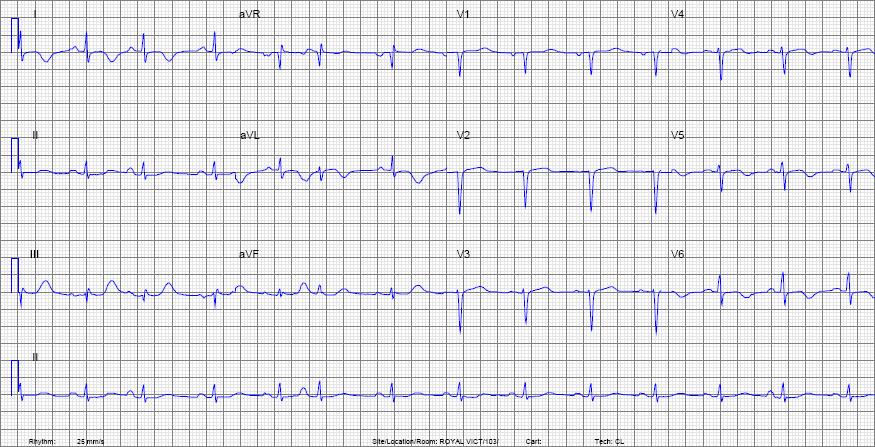 premature atrial beats