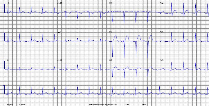 sinus tachycardia