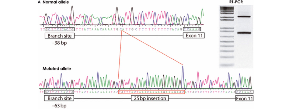 GABA<sub>A</sub> Receptors in Human Epilepsy