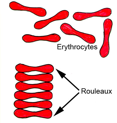 Erythrocyte Sedimentation Rate Esr High
