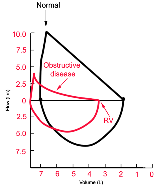 Obstructive Vs Restrictive Lung Disease Chart